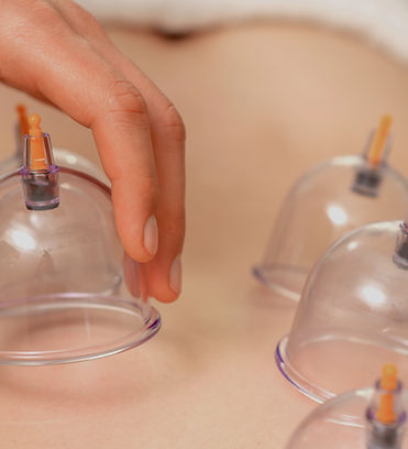 Cupping Therapy