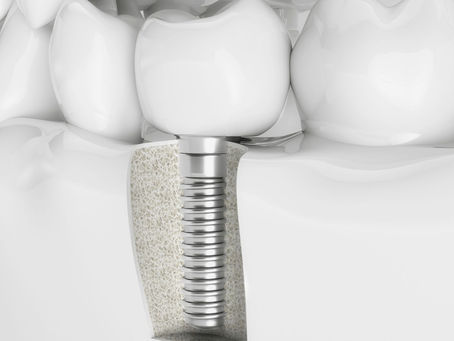 All On X Dental Implants: Procedure, Advantages & Maintenance