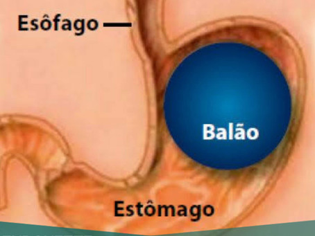 Balão Intragástrico x Bariátrica por Endoscopia