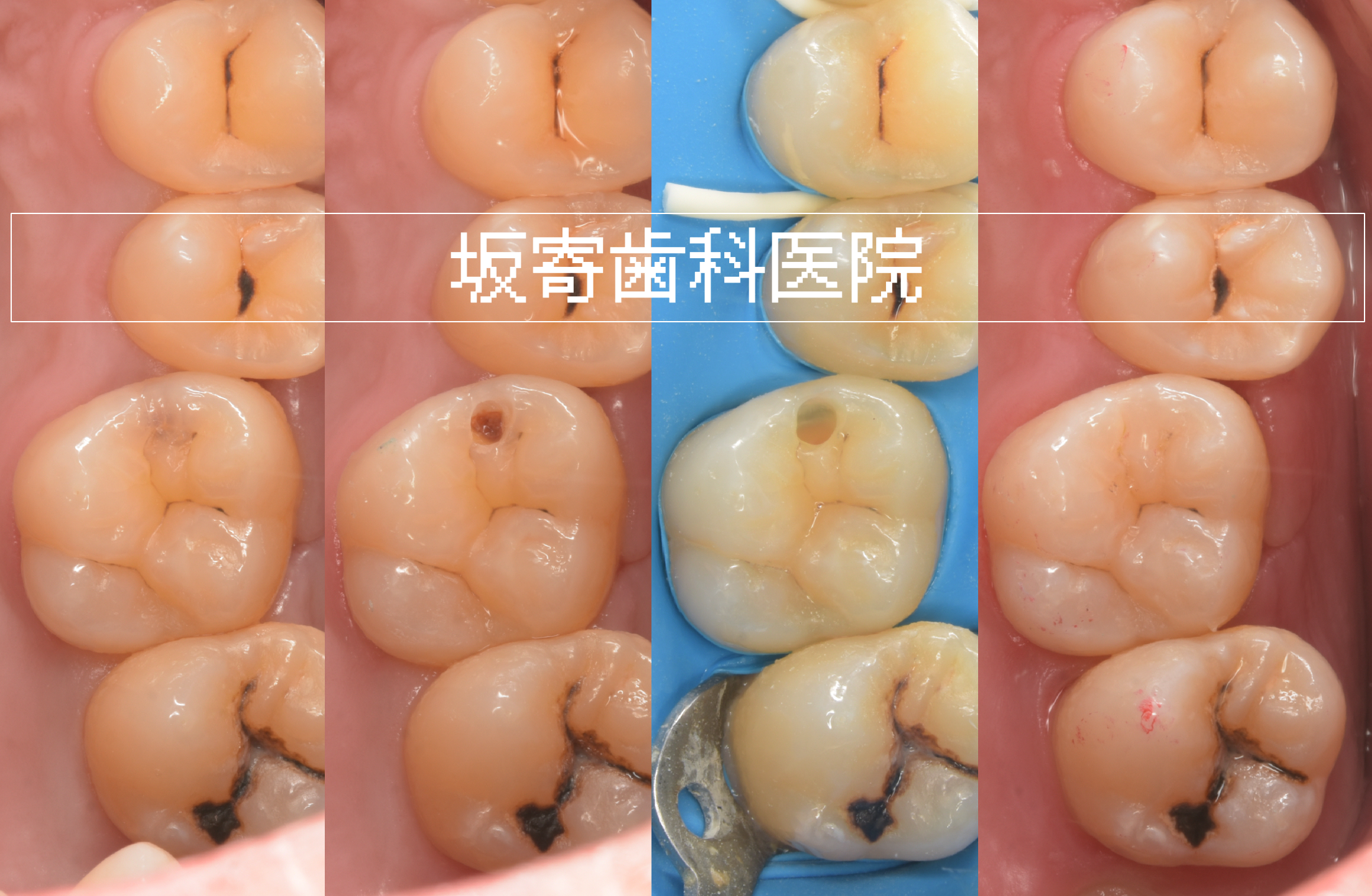 ダイレクトボンディング症例：右上6 むし歯治療（20代男性）術前・術後比較写真