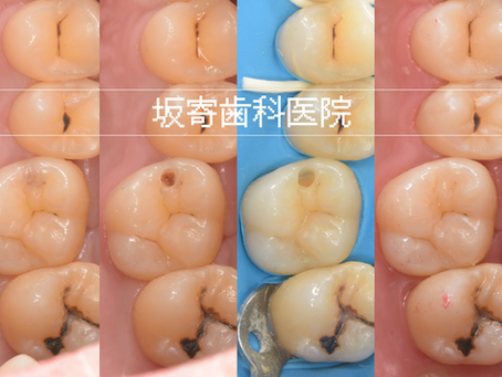 むし歯の必要性を確認して最小限に治療|ダイレクトボンディング症例(右上6・20代男性)