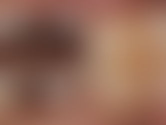 奥歯の自費の白い詰め物。術後数週間後もあります。