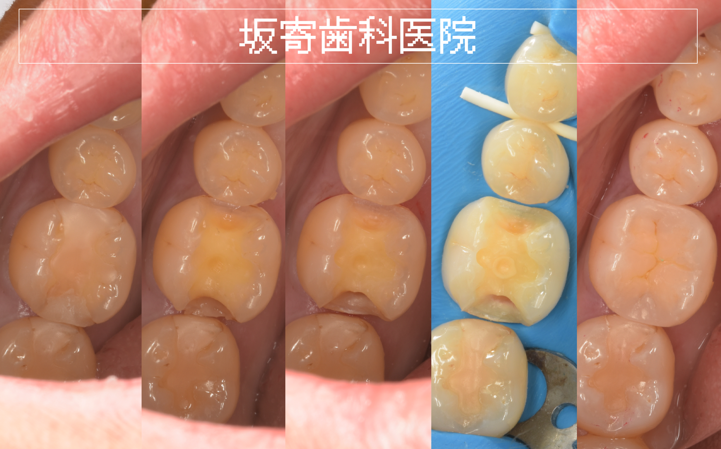 ダイレクトボンディング症例：右下6 セラミックインレー破損の再治療（40代女性）術前・術後比較写真