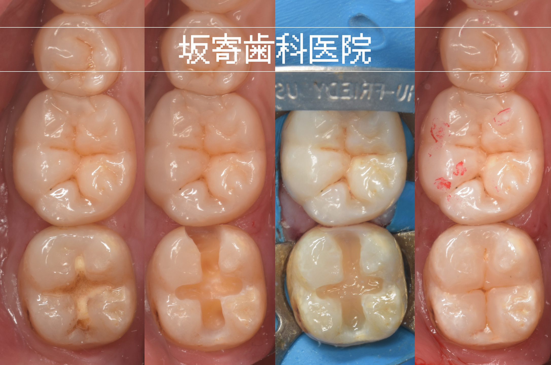 ダイレクトボンディング症例：下顎奥歯 むし歯治療・歯を最大限保存（30代男性）術前・術後比較写真