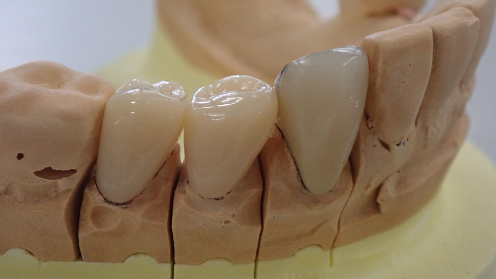 CAD/CAM冠について