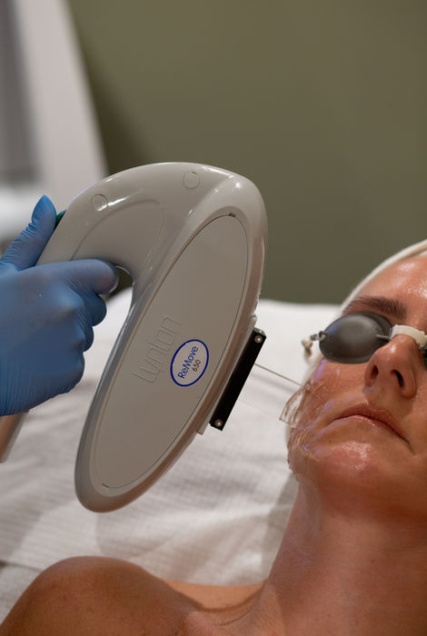 LYNTON LASER SKIN REJUVENATION TREATMENTS