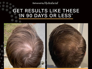 Keravive Scalp & Hair Treatment
