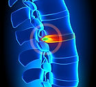 Herniated disc