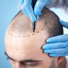 Hair-Transplant-Header-SQUARE.webp