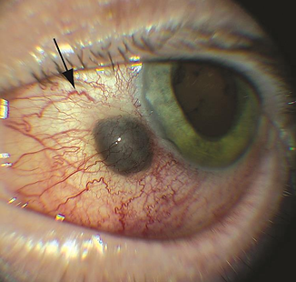 Iris/Ciliary Tumour Overview