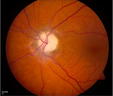 Primary Optic Disc Atrophy