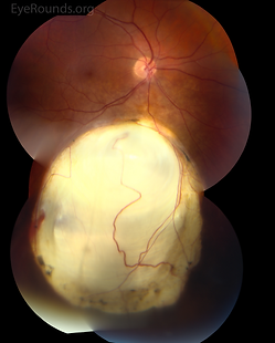 Chorioretinal Coloboma