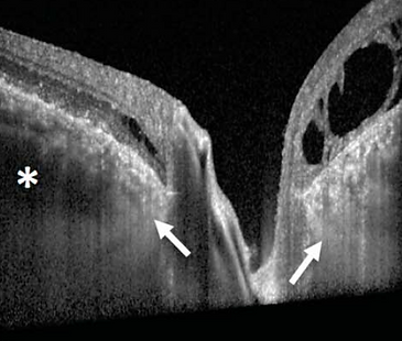 Peripapillary Pachychoroid Syndrome