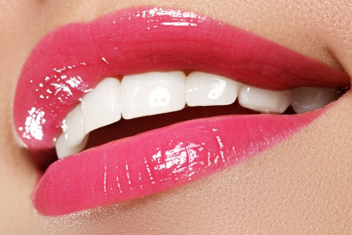 Veneers in DeltaNordel Dental Clinic