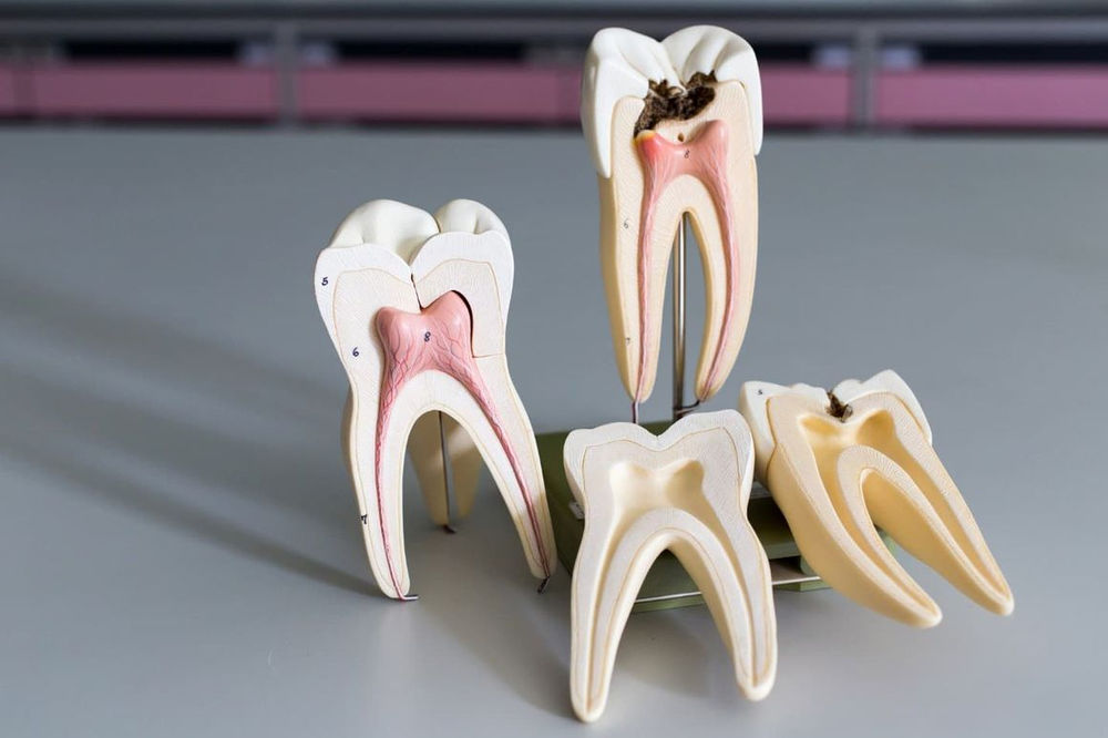 Root Canal vs Dental Implant Nordel Dental Clinic