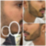 Male client in Dubai enjoying a fuller beard look after SMP treatment.