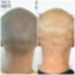 Scalp Micropigmentation in DUbai SMP