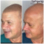 Bald man in Dubai with convincing hairline after SMP procedure.