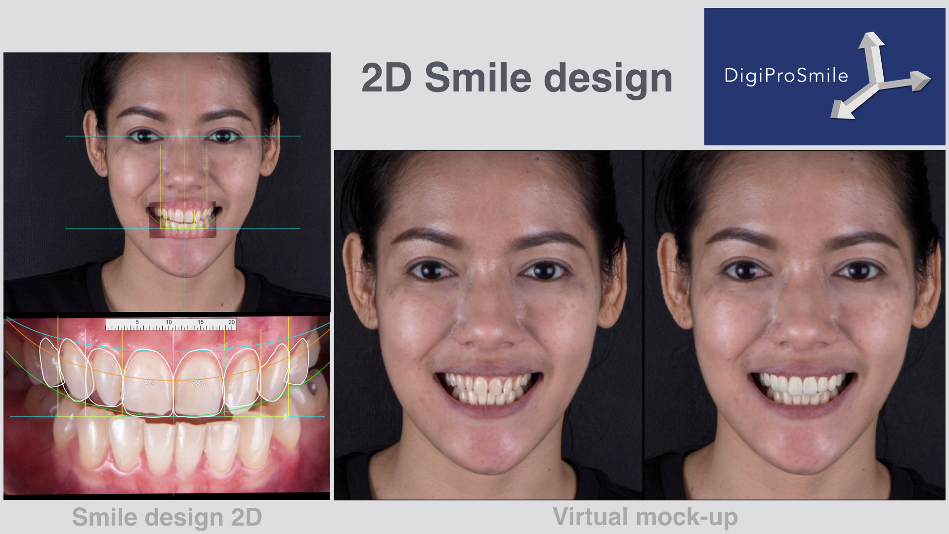 2D Smile design | digiprosmile