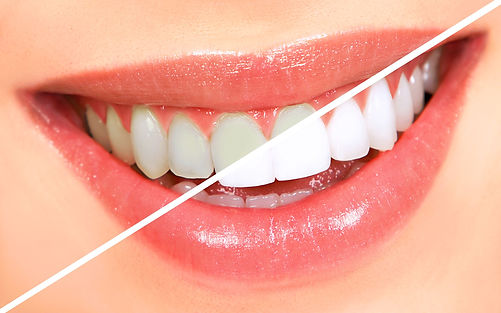 tooth-whitening.jpg
