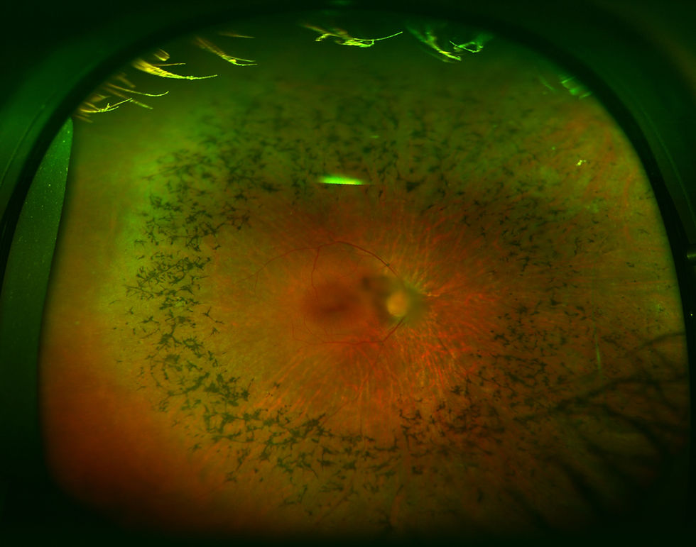 Retinitis pigmentosa