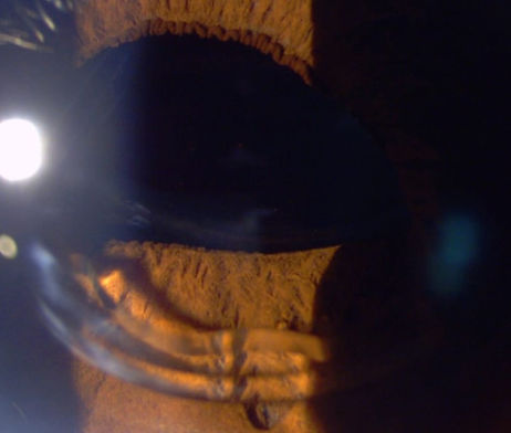 dislocatede lens.jfif