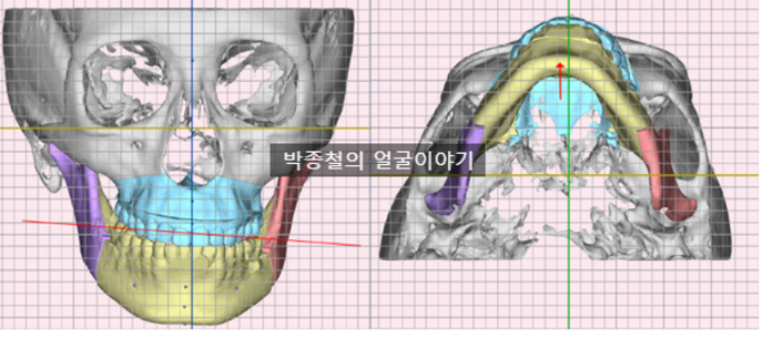 수술 시뮬레이션