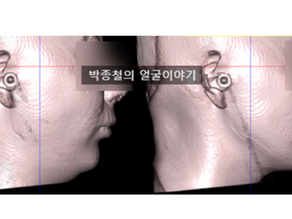 무턱 양악 수술, 숨겨진 얼굴 라인 찾아드립니다!