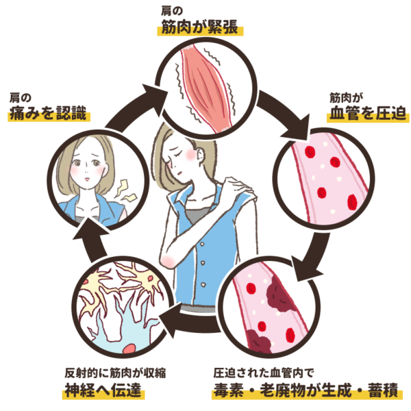 肩こり負のサイクル.webp