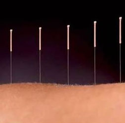 tratamento de acupuntura