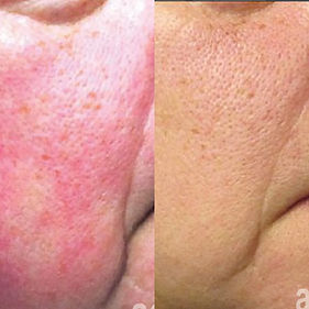 Aerolase Before and After Rosetia.jpg