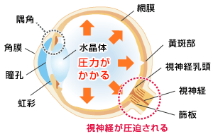 緑内障になった場合の水晶体の状態