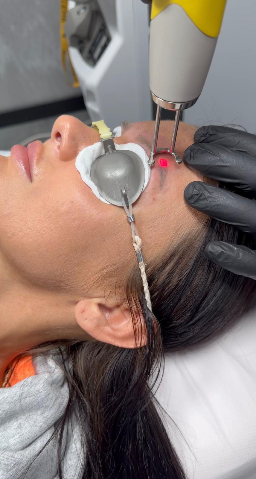 Trendy v obočí sa menia: Ako bezpečne odstrániť starý permanentný make-up
