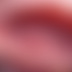 Stages of Endometriosis and Their Impacts