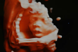3D/4D Ultrasound