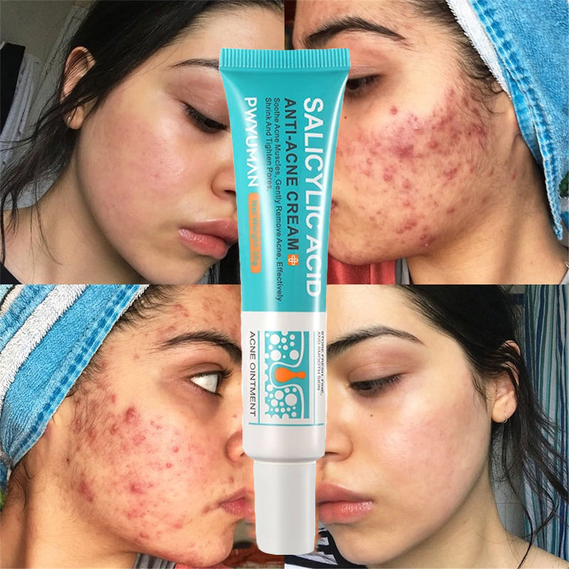 Thumbnail: Salicylic Acid Acne Removal Cream Anti-Acne Repair Redness Pimple Spots Deep Cle