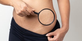 Top 5 Myths About Stretchmarks — And the Truth Behind Them