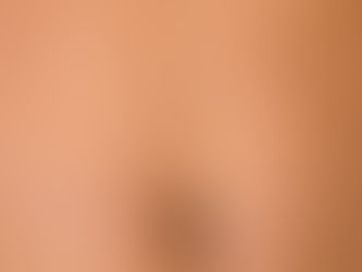 The Science of Smooth Skin: How Inkless Stretch Mark Revision Works