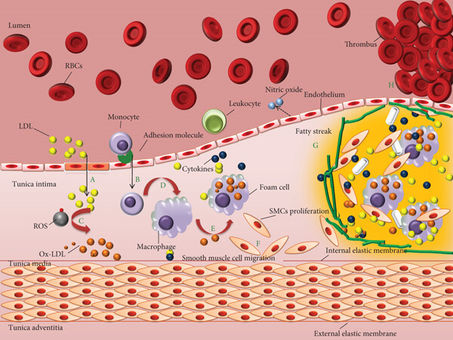 Pathophysiology of Atherosclerosis: How Heart Disease Really Begins - Part 2