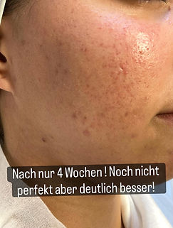 aknebehandlung