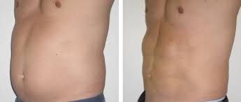 pancia uomo cellulite.jpg