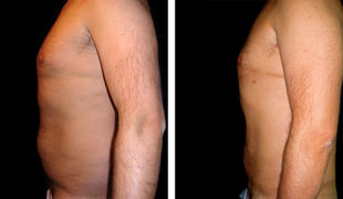 uomo pancia cellulite.jpg