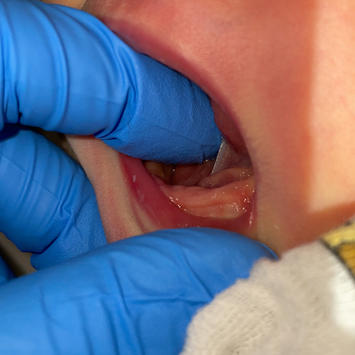 Tongue Tie Example
