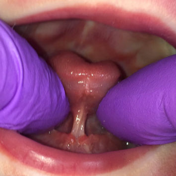 Tongue Tie Example