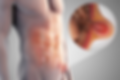 hernia inguinal.png