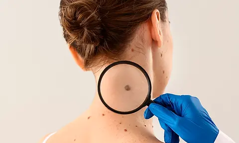 EXERESE REMOÇÃO DE PINTAS.webp