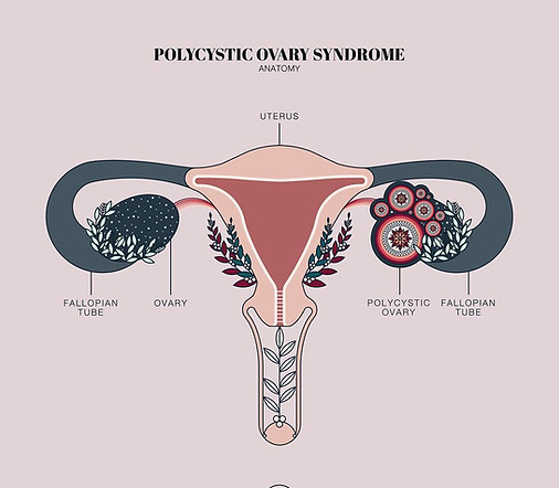 PCOS-Illustration.jpg