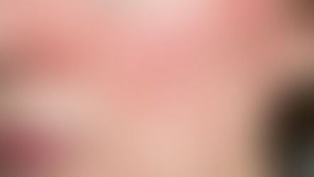 Rosacea treatment in London