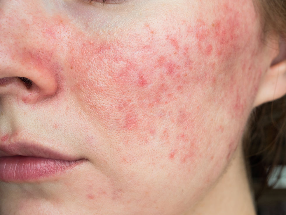 Rosacea treatment in London