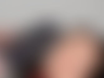 Refresh Your Look with Tear Trough & Mid-Face Fillers